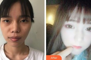 柳州市中医医院眼科李静波整形价格表附眼部综合案例展示