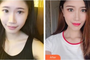 桂林医学院第二附属医院眼科秦程整形价格表附切开双眼皮案例展示