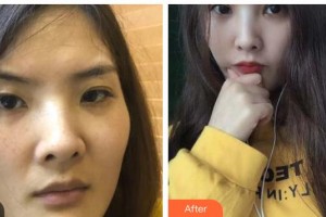 桂林医学院第二附属医院眼科许行艳整形价格表附切开双眼皮案例展示