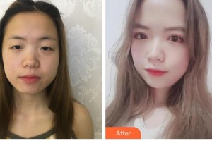 桂林医学院第二附属医院眼科黄雪英整形价格表附切开双眼皮案例展示