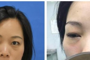 桂林医学院第二附属医院眼科王莉整形价格表附激光去眼袋案例展示