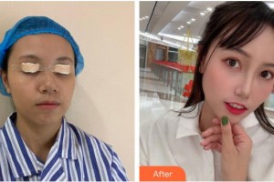 桂林市人民医院眼科钟旭整形价格表附眼部综合案例展示