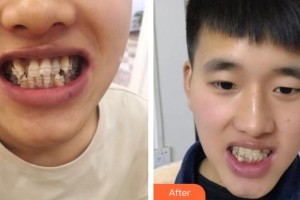 梧州华美整形美容医院孔华锋整形价格表附隐形托槽矫正案例展示