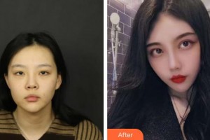 北海韩美医疗美容门诊部杨双辉整形价格表附埋线双眼皮案例展示