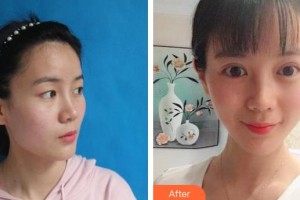 北海美秀中禾医疗美容诊所常英整形价格表附切开双眼皮案例展示