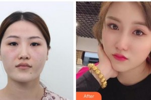 钦州市第一人民医院医疗整形美容激光中心刘良整形价格表附切开双眼皮案例展示