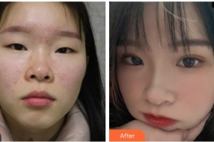 贵港爱尔眼科医院唐健青整形价格表附眼部综合案例展示