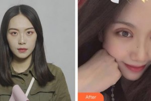 贵港爱尔眼科医院梁岸整形价格表附眼部综合案例展示