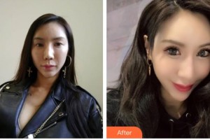 贵港爱尔眼科医院潘可生整形价格表附切开双眼皮案例展示
