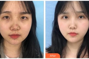 玉林华美整形美容医院朴洪权整形价格表附眼部综合案例展示