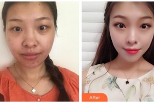 玉林华美整形美容医院刘慧整形价格表附眼部综合案例展示