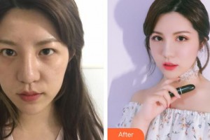 玉林爱尔眼科医院卢荣强整形价格表附眼部修复案例展示