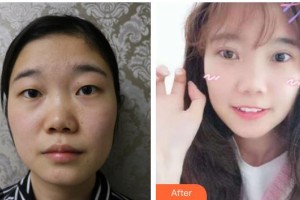 玉林爱尔眼科医院李平整形价格表附切开双眼皮案例展示