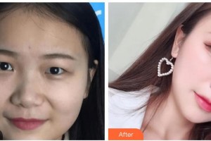 玉林爱尔眼科医院张熙健整形价格表附眼部综合案例展示