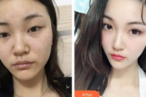 玉林爱尔眼科医院王碧华整形价格表附眼部综合案例展示
