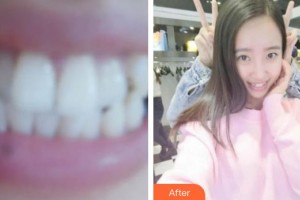 海口杭牙维信口腔门诊部杨惦山整形价格表附牙齿隐形矫正案例展示