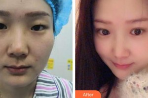 孝感爱尔眼科医院熊炜整形价格表附眼部综合案例展示