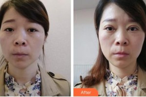 孝感爱尔眼科医院叶刚整形价格表附切开双眼皮案例展示