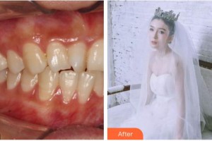 鄂州中山口腔医院王向荣整形价格表附牙齿隐形矫正案例展示