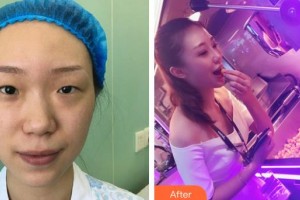武汉儿童医院李世莲整形价格表附切开双眼皮案例展示