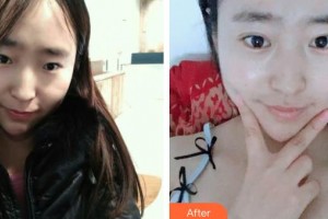 武汉艾格眼科医院黄鹏程整形价格表附眼部综合案例展示