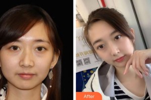 十堰阳光整形医院黄金井整形价格表附热玛吉案例展示
