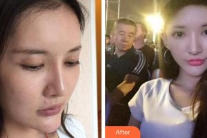十堰市人民医院整形美容烧伤外科王建国整形价格表附埋线提升案例展示