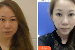十堰市人民医院整形美容烧伤外科陆华整形价格表附埋线提升案例展示