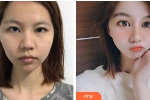十堰爱尔眼科医院张青松整形价格表附热拉提案例展示