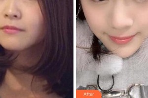 十堰市人民医院整形美容烧伤外科王鹏整形价格表附热拉提案例展示