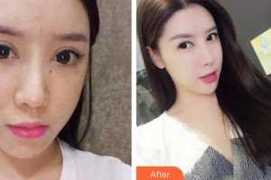 襄阳市中心医院整形美容科姚春莲整形价格表附激光祛斑案例展示