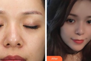 萍乡百丽恒医疗美容诊所徐应胤整形价格表附热拉提案例展示