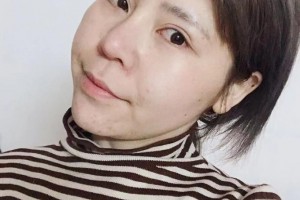 新余嘉和医疗美容门诊部崔亚鹏整形价格表附眼部手术案例展示