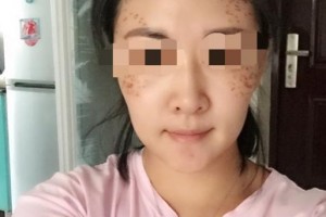 赣州明珠丽格医疗美容医院陈岩青整形价格表附埋线提升案例展示