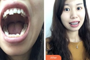 昆山益达口腔门诊部徐恒整形价格表附金属托槽矫正案例展示
