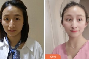 盐城朝聚眼科医院胡恩海整形价格表附切开双眼皮案例展示