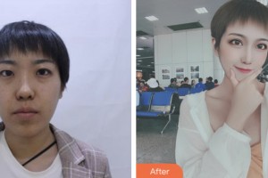 宿迁华美创和医疗美容医院周思齐整形价格表附眼部综合案例展示