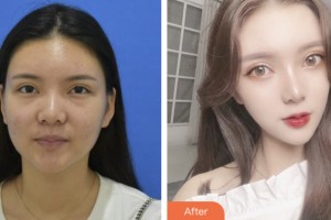 淮安市妇幼保健院医疗美容科王川颖整形价格表附激光去眼袋案例展示