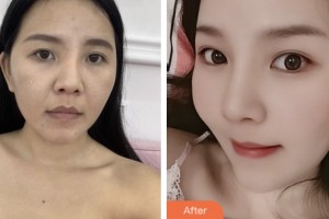 拉萨维多利亚整形美容医院徐杰明整形价格表附牙齿隐形矫正案例展示