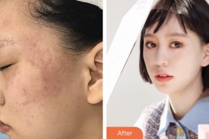 荆门市第二人民医院医学整形美容中心戴明英整形价格表附激光美肤激光案例展示