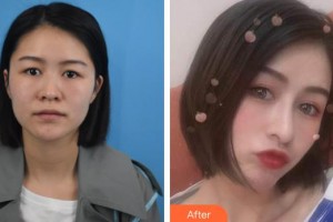 湘潭阳光整形美容门诊部刘洋整形价格表附肋软骨隆鼻案例展示