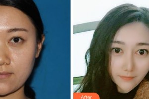 湘潭雅美医疗美容医院杨奇元整形价格表附耳软骨复合隆鼻案例展示