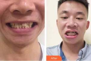 永州牙博士口腔医院唐林平整形价格表附牙齿隐形矫正案例展示