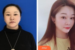 银川爱美丽医疗美容门诊部金敏慧整形价格表附埋线提升案例展示