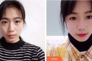 商洛中医医院烧伤整形科李怀善整形价格表附切开双眼皮案例展示