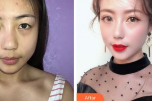 解放军总医院第一附属医院烧伤整形科柴家科整形价格表附切开双眼皮案例展示