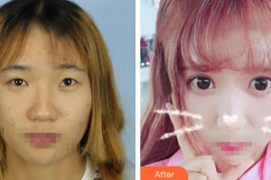 解放军总医院第一附属医院烧伤整形科盛志勇整形价格表附眼部综合案例展示