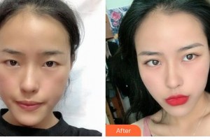 解放军总医院第一附属医院烧伤整形科京萨整形价格表附切开双眼皮案例展示