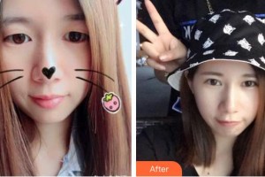 解放军总医院第一附属医院烧伤整形科郝岱峰整形价格表附埋线双眼皮案例展示