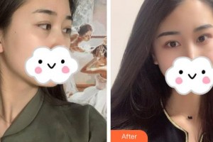 解放军411医院激光整形中心赵烨德整形价格表附内切祛眼袋案例展示